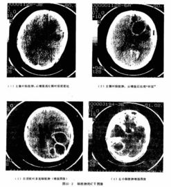 Giá tốt. Máy in Laser trong suốt X Ray Phim y tế khô 8 × 10 inch trực tuyến