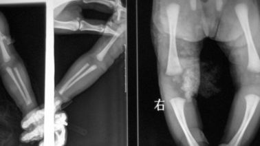 Good price 20 x 25cm Laser X Ray Hình ảnh Y tế, Phim DT1B / DT2B Agfa X Ray trực tuyến