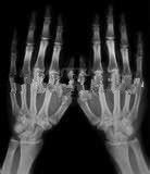 Good price 13in * 17in Phim sương mù y tế Xray thấp cho máy in Laser Konida trực tuyến