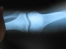 Good price Giấy Xray y tế chống trầy xước 25cm * 30cm cho máy in Laser Konida trực tuyến