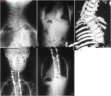 Bảo hiểm chẩn đoán hình ảnh X Ray cao, phim x quang Laser y tế 35 x 43cm