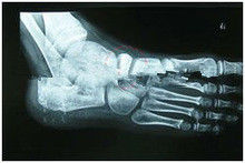 Good price 13in x 17in Giấy chẩn đoán hình ảnh X Ray phân hủy cho máy in Laser trực tuyến