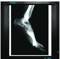 Good price Hình ảnh chẩn đoán y tế 20 cm x 25cm, Máy in Laser Phim X Ray trực tuyến