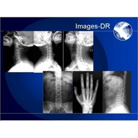 Hệ thống X-quang kỹ thuật số DR Portable, Hệ thống X-RAY của Mammogrpahy