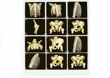 Chẩn đoán hình ảnh X-quang trắng có thể đeo được, Phim y tế Laser Blue X Ray
