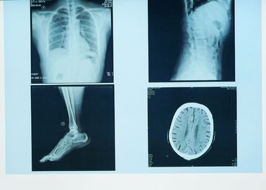 Hình ảnh chẩn đoán X X bền, Phim y tế 32cm x 43cm Laser Blue X Ray