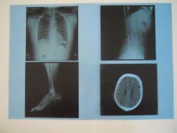 Good price Phim chụp ảnh khô y tế sương mù thấp KND-A để kiểm tra X Ray trên AGFA 5300/5 530/5500 trực tuyến