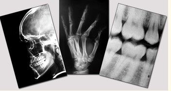 Good price Phim chụp ảnh khô y tế màu xanh, phim 11in x 14in Laser Fuji X Ray trực tuyến
